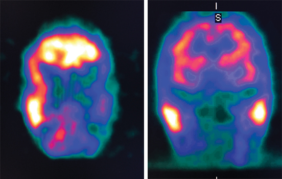 These brain scans show a patients brain before and after Dr Foxs full hyperbaric oxygen treatment The scans show vast improvement in terms of blood flow to the entire brain  